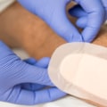 The Best Dressings for Open Wounds: An Expert's Perspective