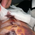 The Importance of Properly Removing Gauze from Wounds